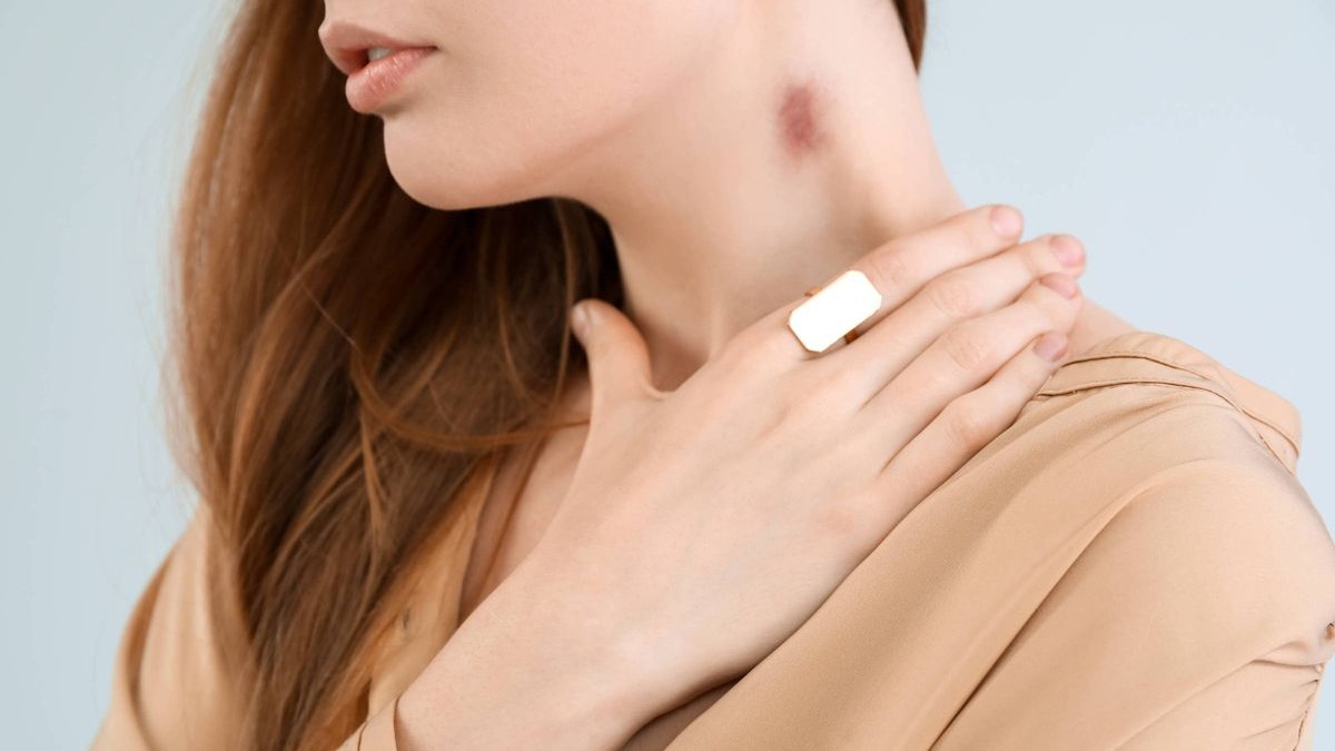 Chupão no pescoço causa AVC em mulher: especialistas alertam para riscos