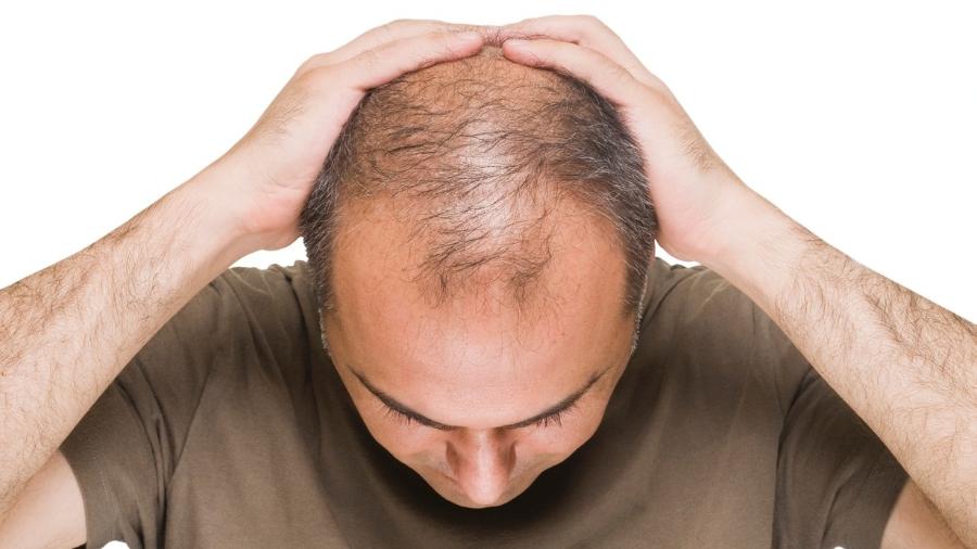 Será o Fim da Careca? Pesquisa Inovadora Dá Nova Vida aos Seus Fios!
