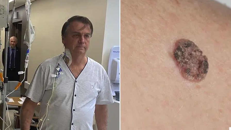 O diagnóstico que abala a política: Bolsonaro está com câncer