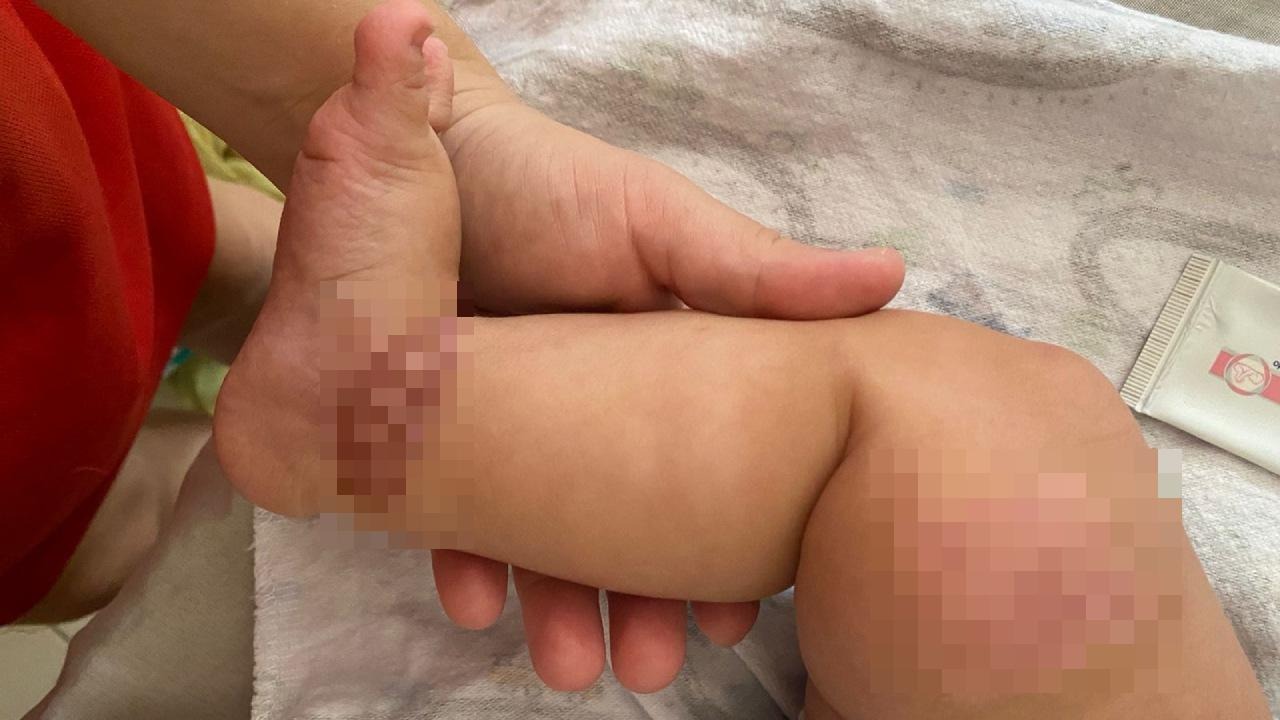 Imagem da notícia: Caso de Necrose em Bebê Causa Repercussão em Hospital do Cariri e Exige Cirurgia Reparadora