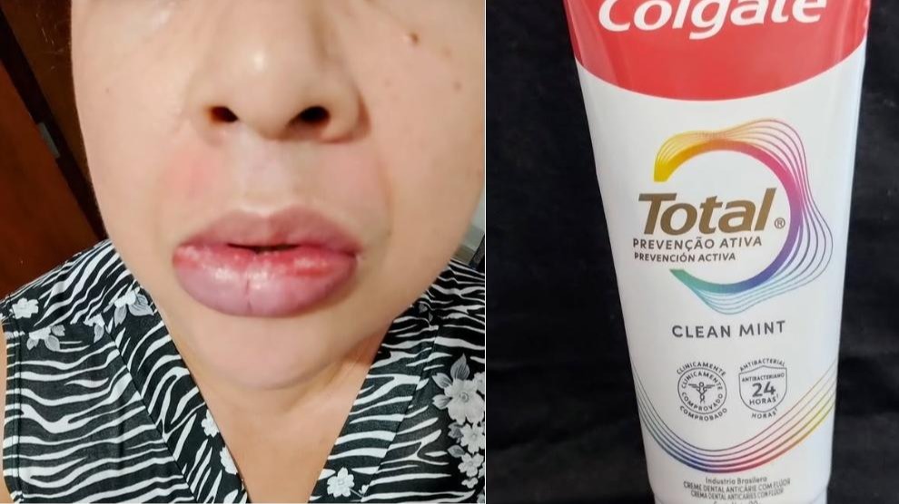 Reação Alérgica Severa Após Uso de Creme Dental Alerta Consumidores em Todo o Brasil